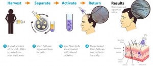 Stem-Cell-Treatment