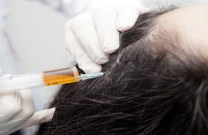 mesotherapy treatment in dubai for hair loss