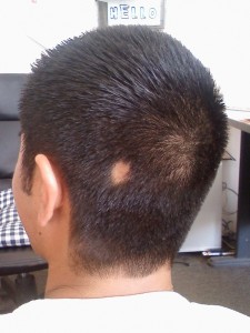 Alopecia bald spot picture