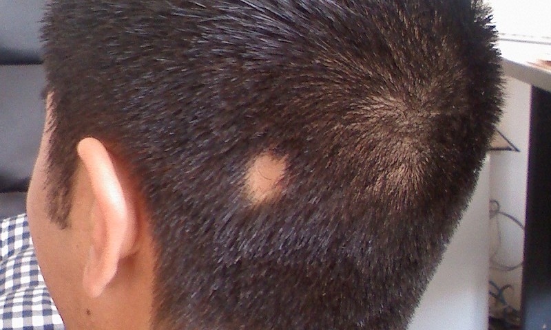 Alopecia bald spot picture