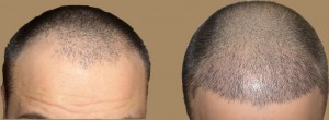 patient before and after_FUE 2700 grafts, 10 days post transplant