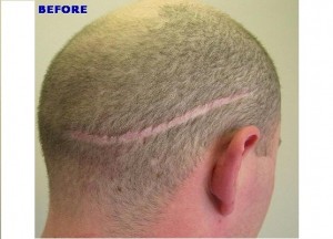 FUT hair transplant in Dubai before after