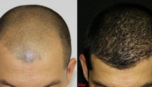 before and after fue hair transplant