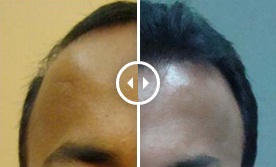 frontal hair restoration in Dubai Clinic
