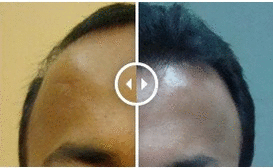 full head hair restoration in dubai