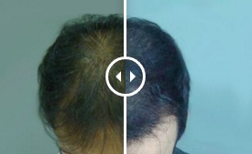 full head hair restoration in dubai