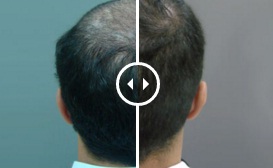 hair transplant for balding crown in Dubai