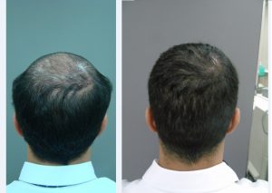 fue hair transplant recovery