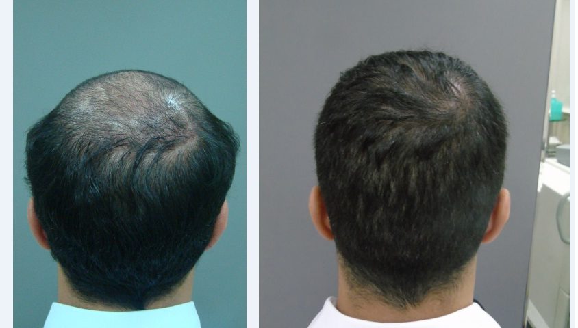 fue hair transplant recovery