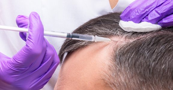Prp Hair loss therapy in Dubai