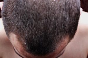 Dandruff and Hair Loss What's the Link