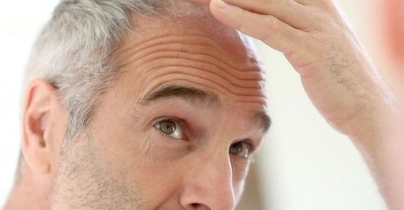 Factors That Affect Hair Transplant’s Longevity
