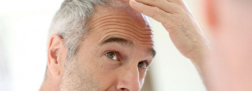Factors That Affect Hair Transplant’s Longevity