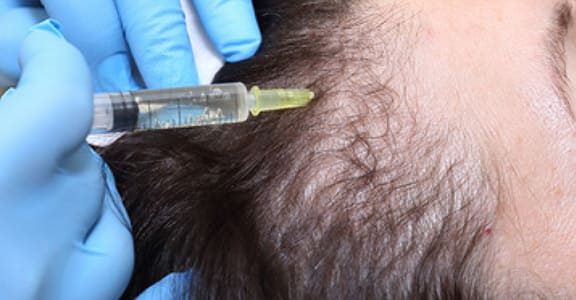 Cosmetic procedure for hair loss