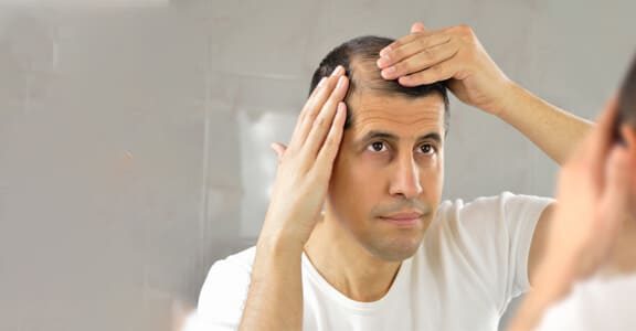 Baldness treatment in Dubai