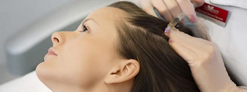 Mesotherapy for Hair Loss Treatment